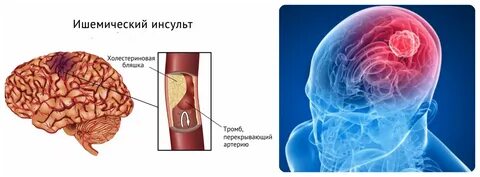 Ишемический инсульт тромб