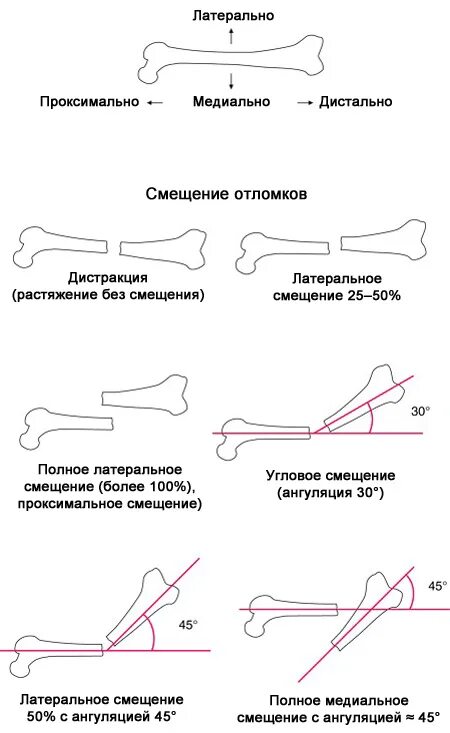 Классификация переломов Ветеринария. Латерально медиально дистально. Классификация смещений костных отломков. Смещение костных отломков латерально.