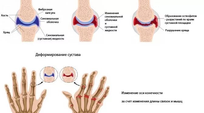 Артрит и артроз разница. Стадии развития артроза. При остеоартрозе поражаются. При деформирующем остеоартрозе поражаются:.
