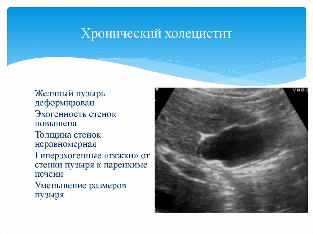 Эхопризнаки желчного пузыря. Хронический холецистит УЗИ картина. УЗИ желчного пузыря острый холецистит. Острый и хронический холецистит на УЗИ. УЗИ желчного пузыря хронический холецистит.