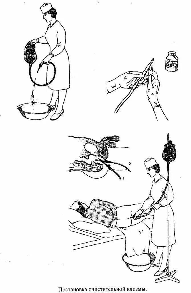 Вода для клизмы должна. Очистительная клизма Кружка Эсмарха алгоритм. Постановка очистительной клизмы алгоритм. Очистительная клизма техника выполнения. Методика постановки очистительной клизмы.