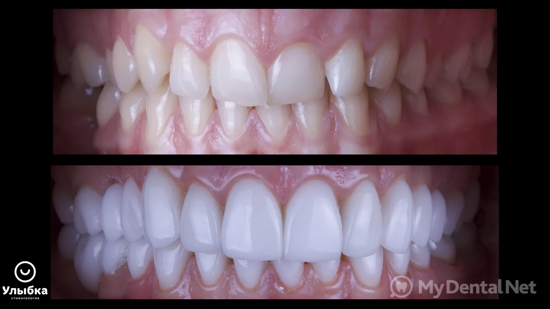 Циркониевые виниры блич 3. Керамические зубы до и после. Циркониевые коронки на передние зубы. Коронки из диоксида циркония на передние зубы. Цирконий зубы до и после.