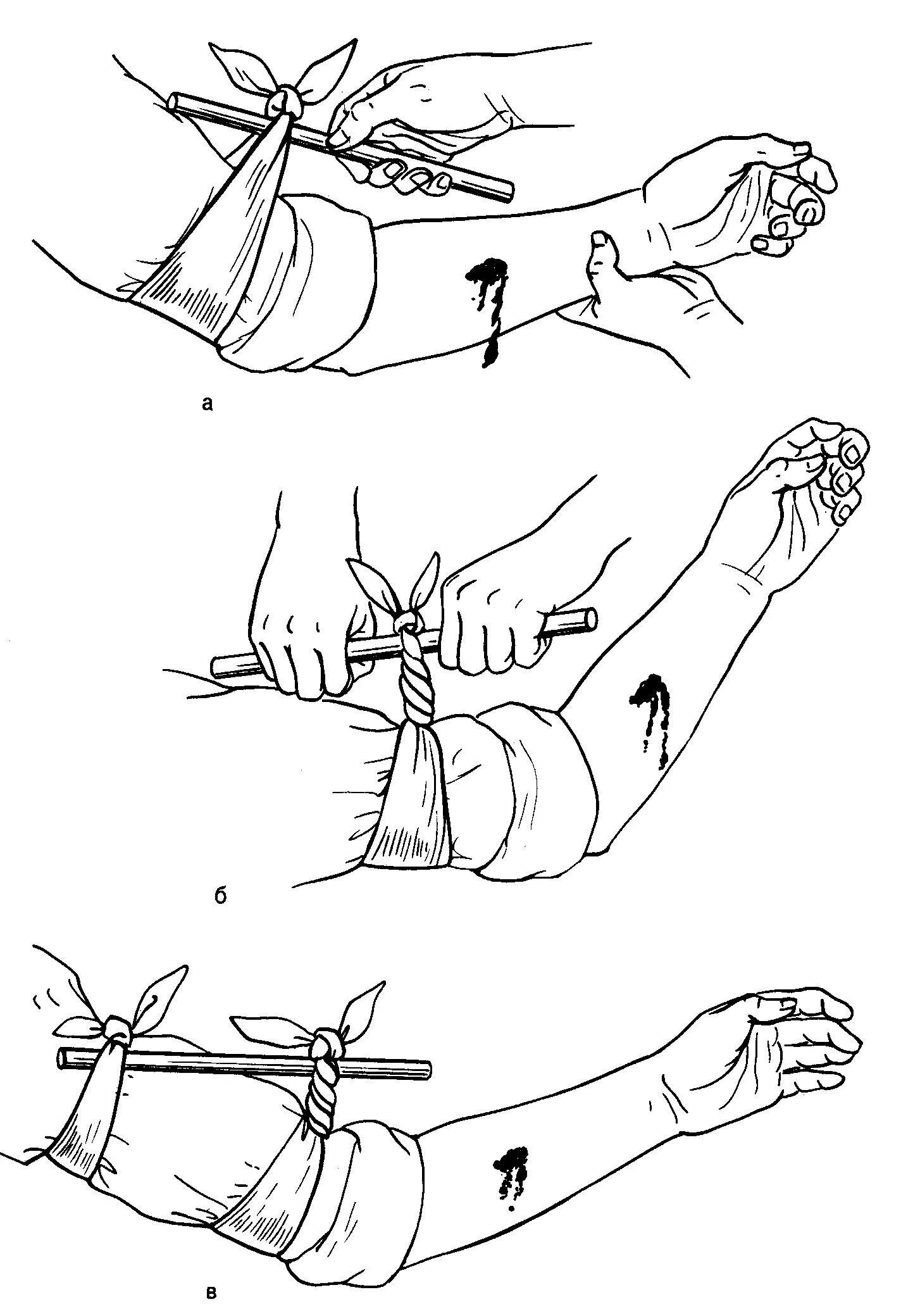 Наложение кровоостанавливающего жгута закрутки. Наложение жгута при кровотечениях. Наложение артериального жгута при артериальном кровотечении.