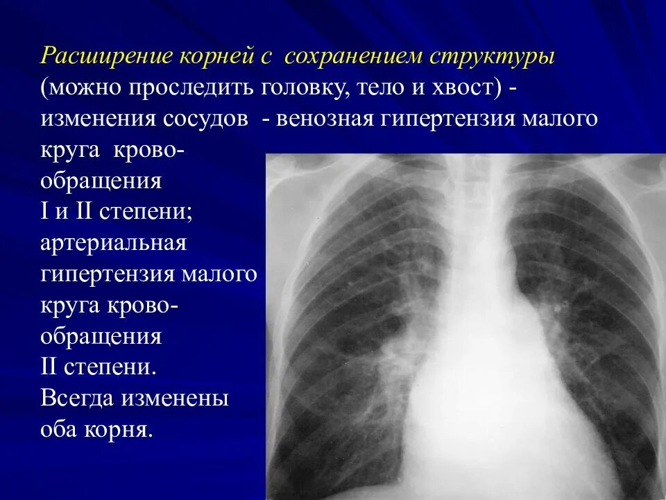 Что значит легкие расширены