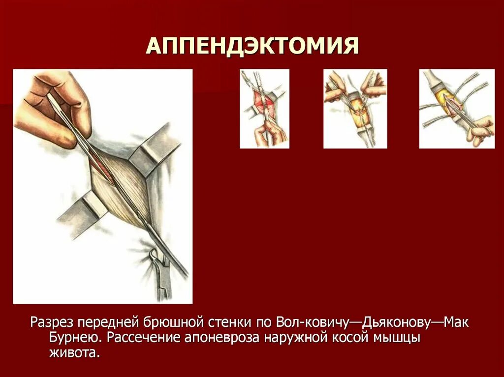 Рассечение термин. Аппендэктомия антеградная рассечение апоневроза. ретроградная аппендэктомия разрез. операция аппендэктомия.