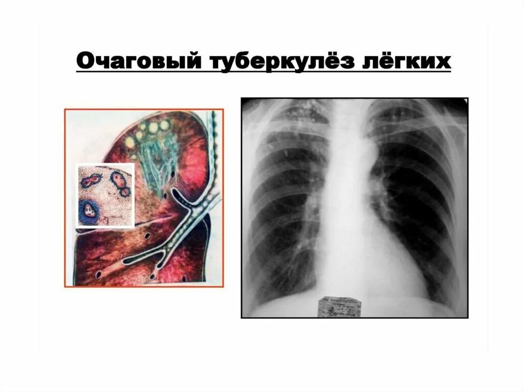 Очаговая форма туберкулеза. Очаговый туберкулез легкого рентген. Очаговый туберкулез легких рентген. Очаговый туберкулез мягкоочаговый. Мелкоочаговый туберкулез легких рентген.