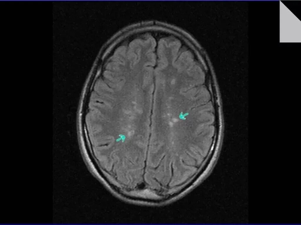 Демиелинизация головного мозга мрт. Туберозный склероз мрт. Мрт мозга рассеянный склероз. Очаги глиоза рассеянный склероз.
