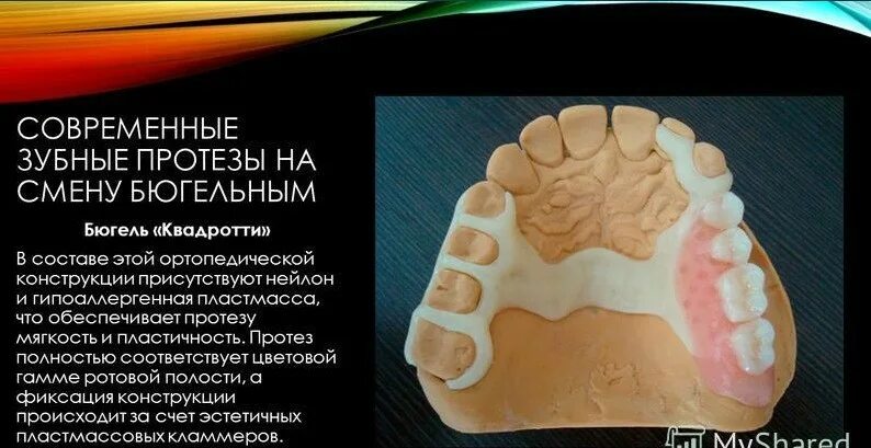Преимущества и недостатки бюгельных протезов. Квадротти протез односторонний. протез квадротти презентация. бюгельный протез квадротти презентация. изготовление протезов квадротти.