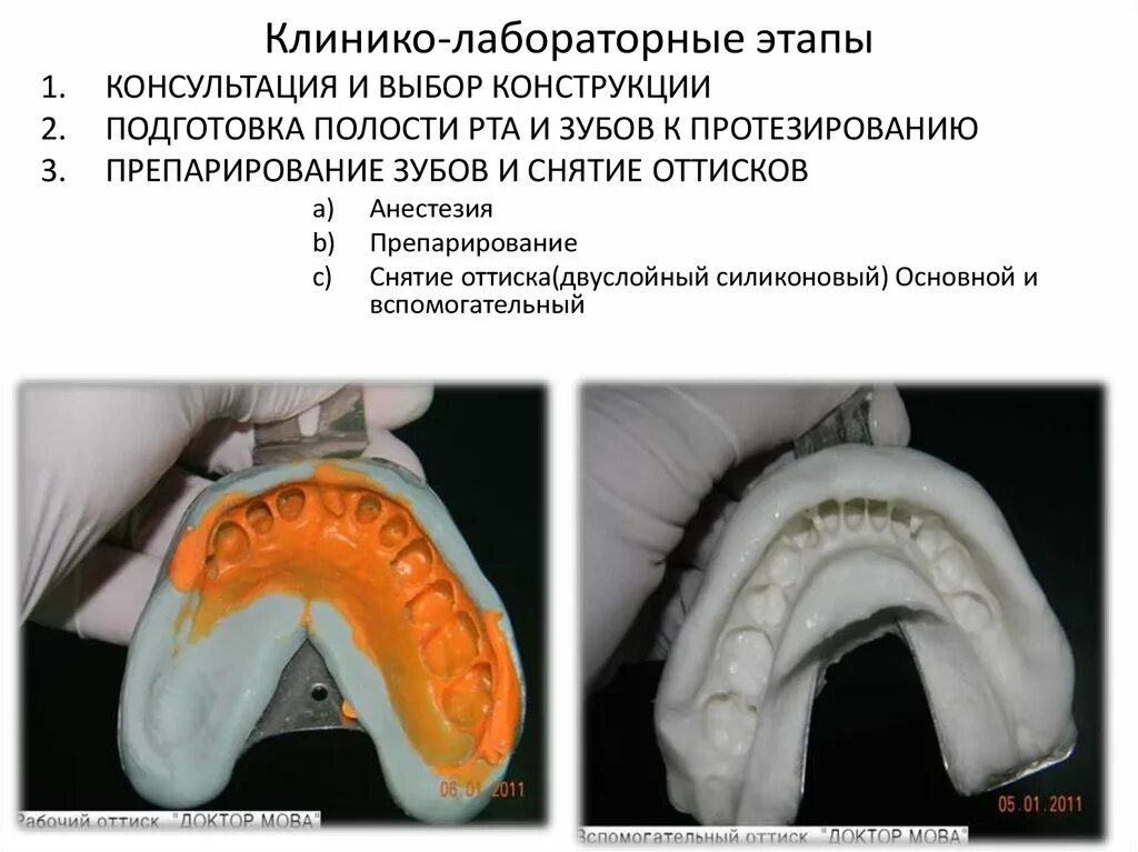 Фарфоровая коронка клинико лабораторные этапы. Пластмассовые и фарфоровые коронки клинико-лабораторные этапы. Клинико-лабораторные этапы изготовления фарфоровой коронки. Двухслойный одноэтапный оттиск. Лабораторные этапы металлокерамической коронки