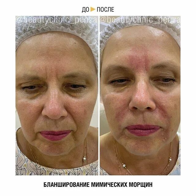 бланширование кисетных морщин. бланширование носогубного залома. бланширование филлером. бланширование филлером. бланширование в косметологии.