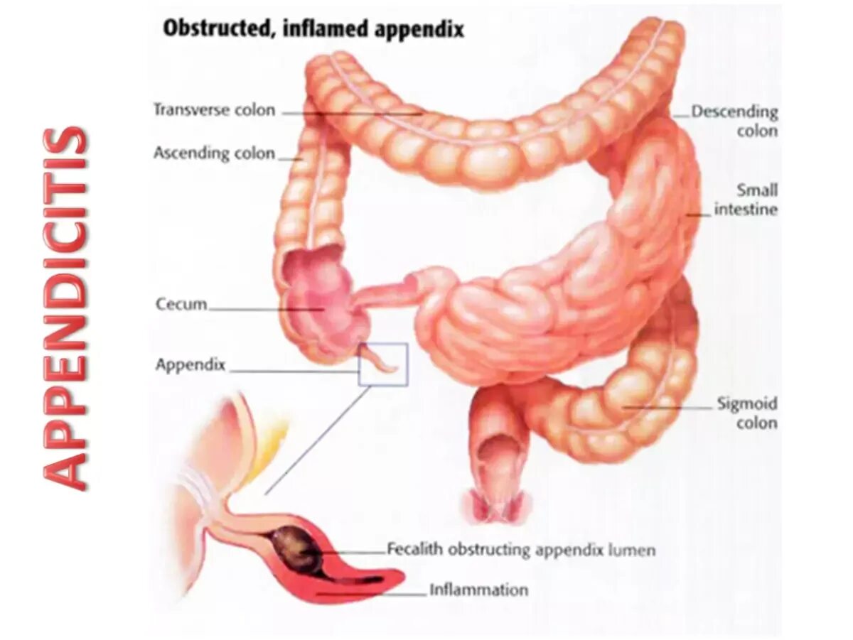 Аппендикс причины появления. Причины появления арендикса. Воспаленный аппендикс. Стул при аппендиците
