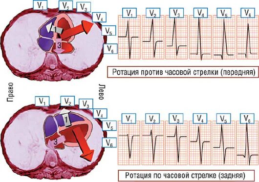 Поворот сердца правым желудочком вперед что это. Повороты сердца на ЭКГ вокруг продольной оси. Поворот сердца по часовой стрелки на ЭКГ. ЭКГ признаки поворота сердца. Ротация сердца против часовой стрелки.