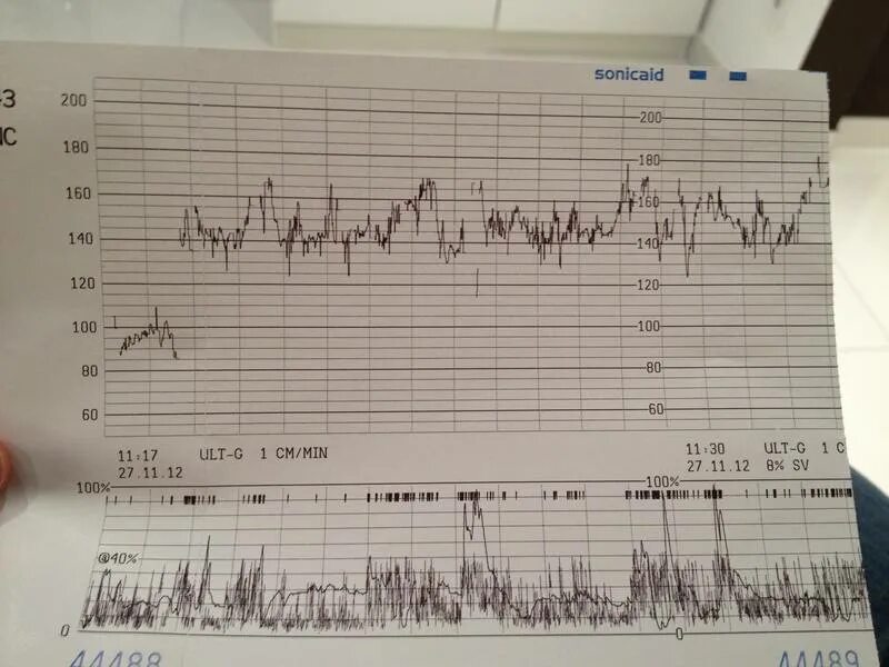 Схватки хиггса. КТГ норма 38 схватки. КТГ при беременности 2 схватки. Схватки на КТГ 40. КТГ 60.