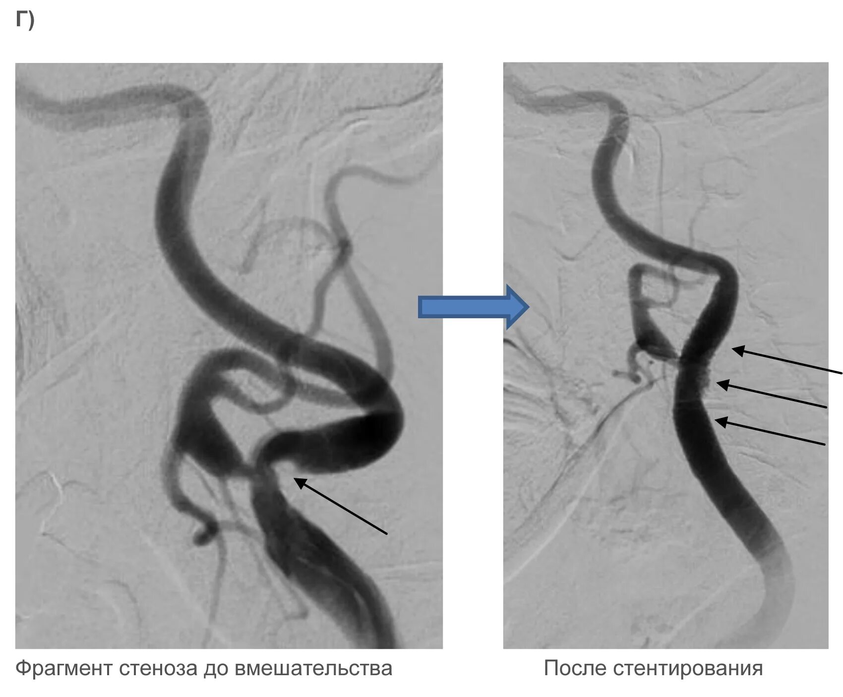 Стеноз устья вса. Стентирование внутренней сонной артерии. Стеноз внутренней сонной артерии стентирование. Стентирование сонной артерии операция. Стентирование брахиоцефальных артерий.