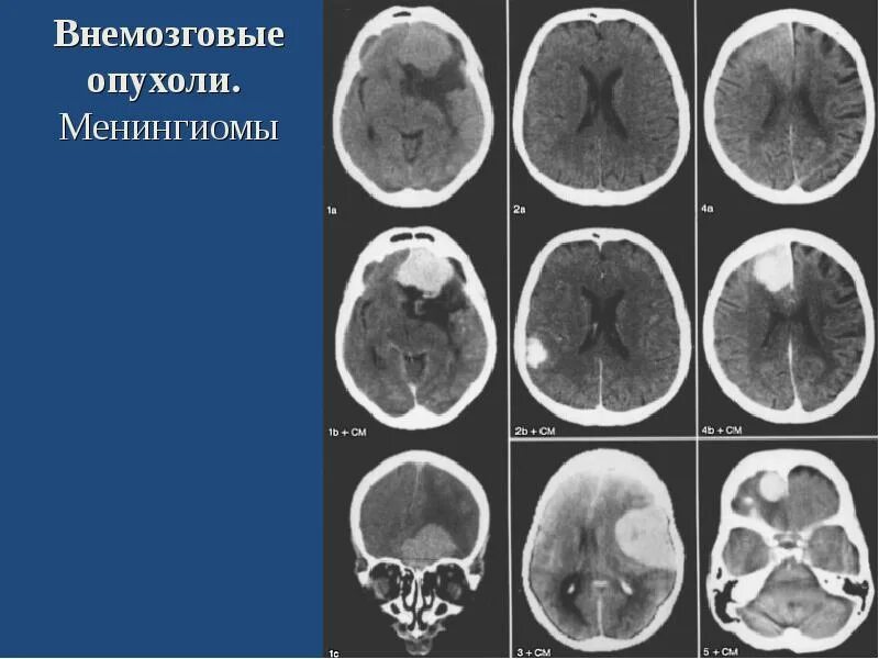 Доброкачественная опухоль головного мозга сколько живут. Менингиома доброкачественная. Менингиомы головного мозга на кт. Внемозговые опухоли головного.