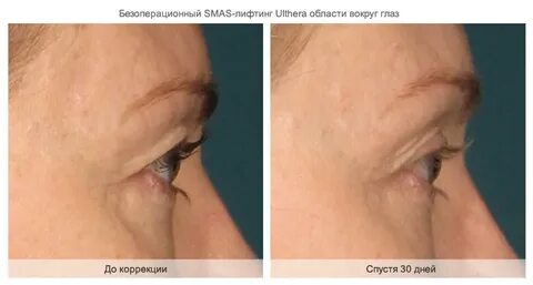 Смас под глаза