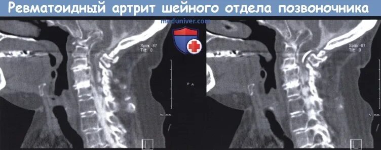 Ревматоидный артрит позвоночника. Ревматизм позвоночника на мрт. Ревматоидный артрит позвоночника симптомы. Ревматоидный артрит шейного отдела. Ревматоидный артрит спина.