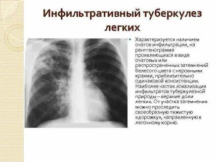 Очаговый и инфильтративный туберкулез
