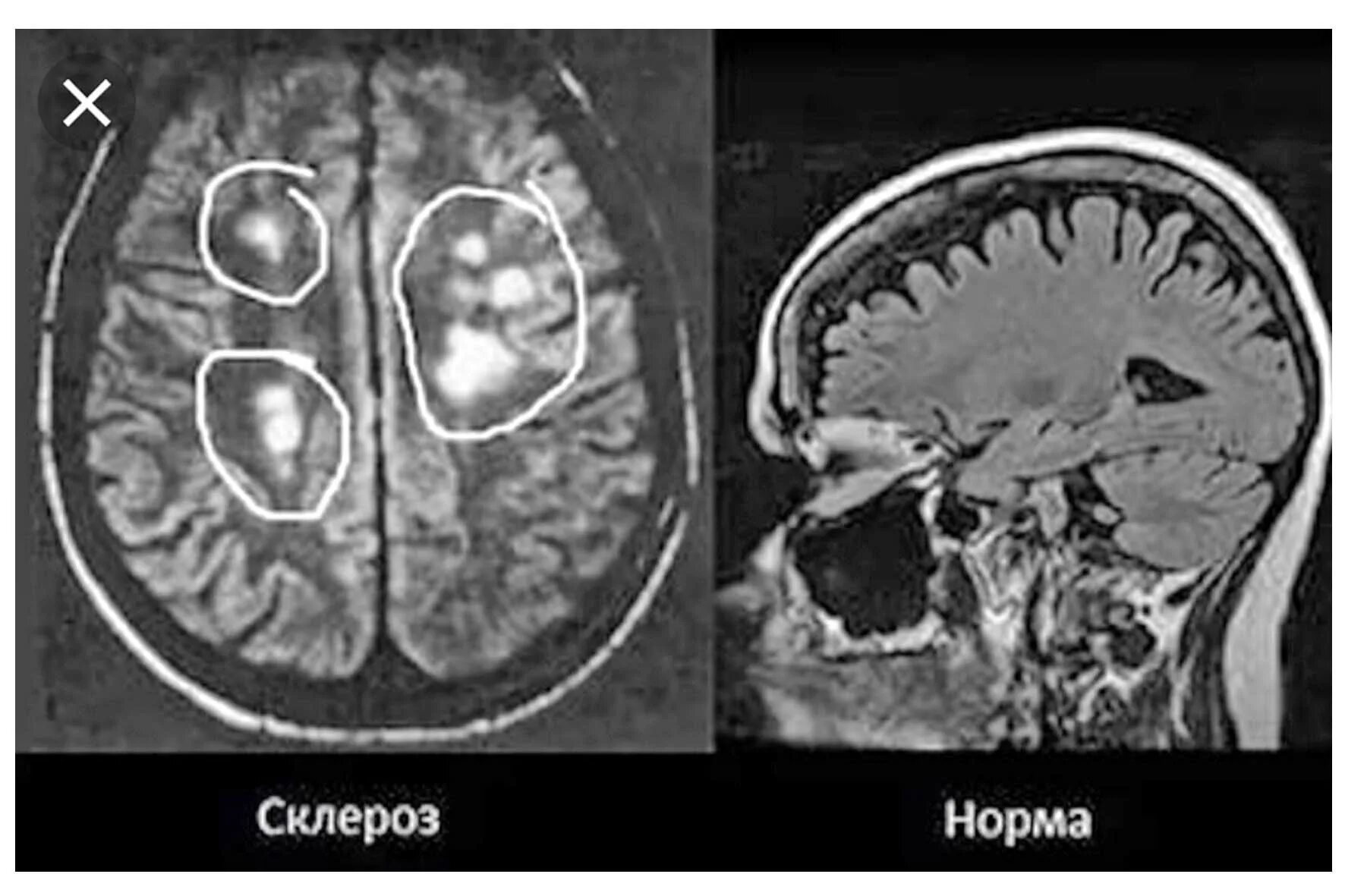 Склероз мозга. Рассеянный склероз симптомы на мрт. G35 рассеянный склероз. Склероз головного мозга. Очаги в мозжечке при рассеянном склерозе.