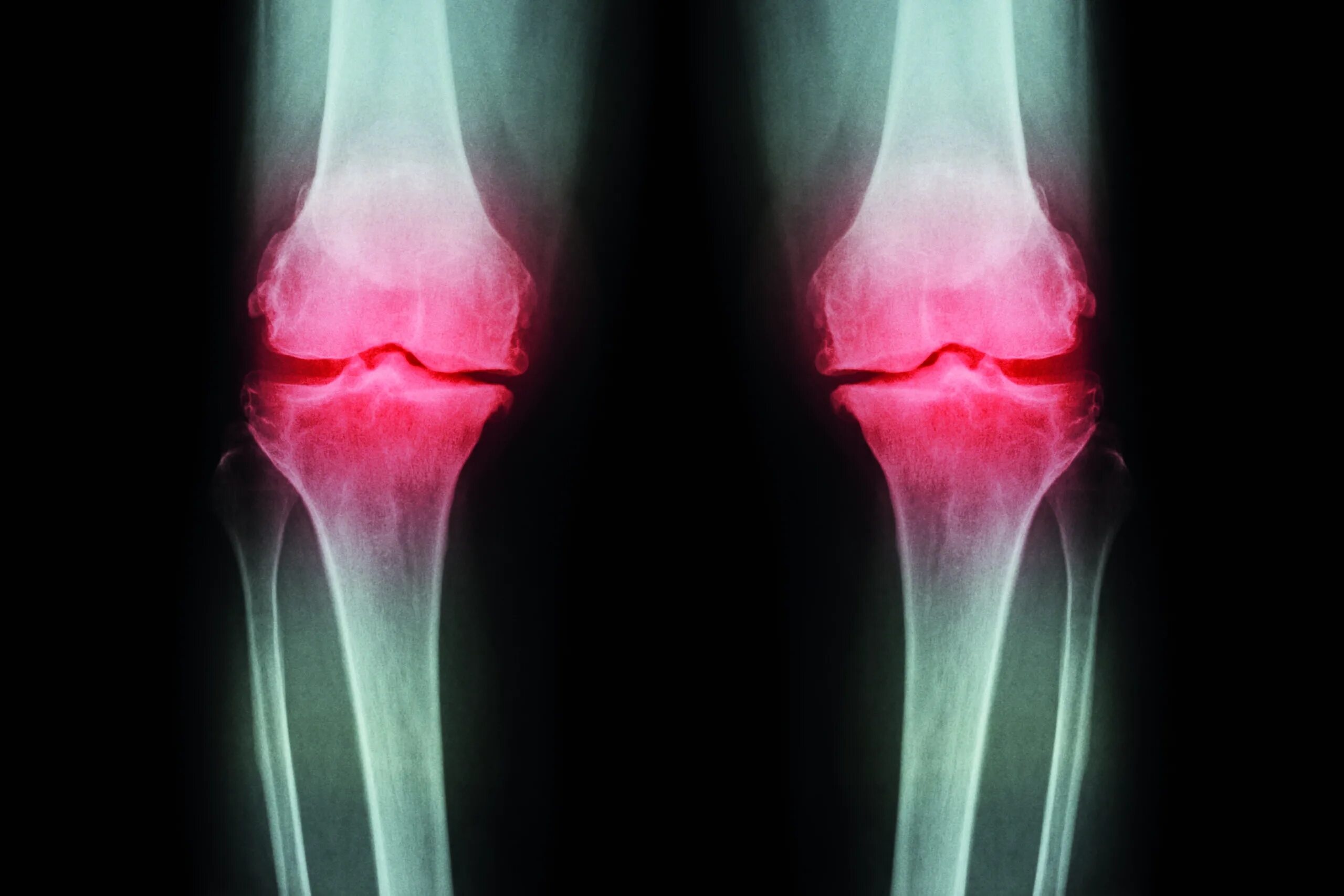Остеоартроз 1 2 степени коленного сустава. Остеоартрит коленного сустава. Артрит коленного сустава.