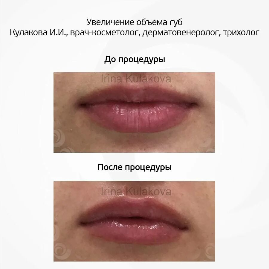 Увеличение губ гиалуроновой кислотой. Коррекция губ гиалуроновой кислотой. Увеличение губ рекомендации. Естественные губы гиалуроновой.
