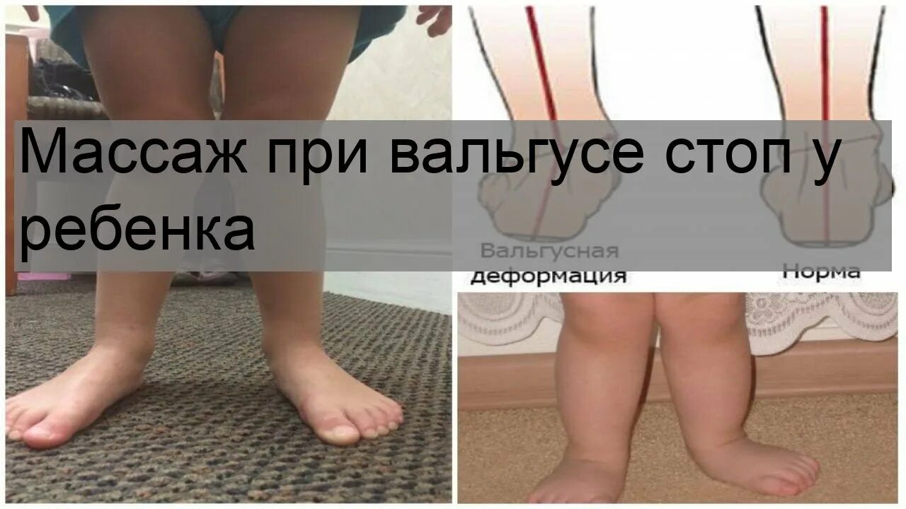 Вальгусная деформация стопы у детей упражнения. Массаж при вальгусе у детей. массаж при вальгусе стоп у детей видео. детский массаж при вальгусе ярославль. массажист детский при вальгусе отзывы.