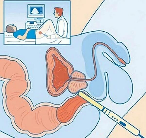 Узи простаты ректально. Пальцевое ректальное исследование предстательной железы. Трансректальное УЗИ простаты. Ультразвуковое исследование предстательной железы трансректальное. УЗИ предстательной железы трансректально.