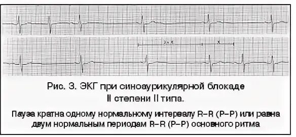 Са блокада 2 тип. Синоатриальная блокада 1 степени на экг. экг при синоатриальной блокаде 3 степени. синоатриальная блокада 2 степени на экг. синоатриальная блокада 2 степени 1 типа на экг.
