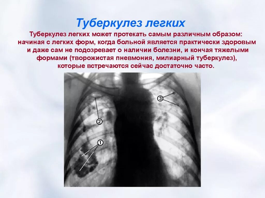 Туберкулез образ жизни