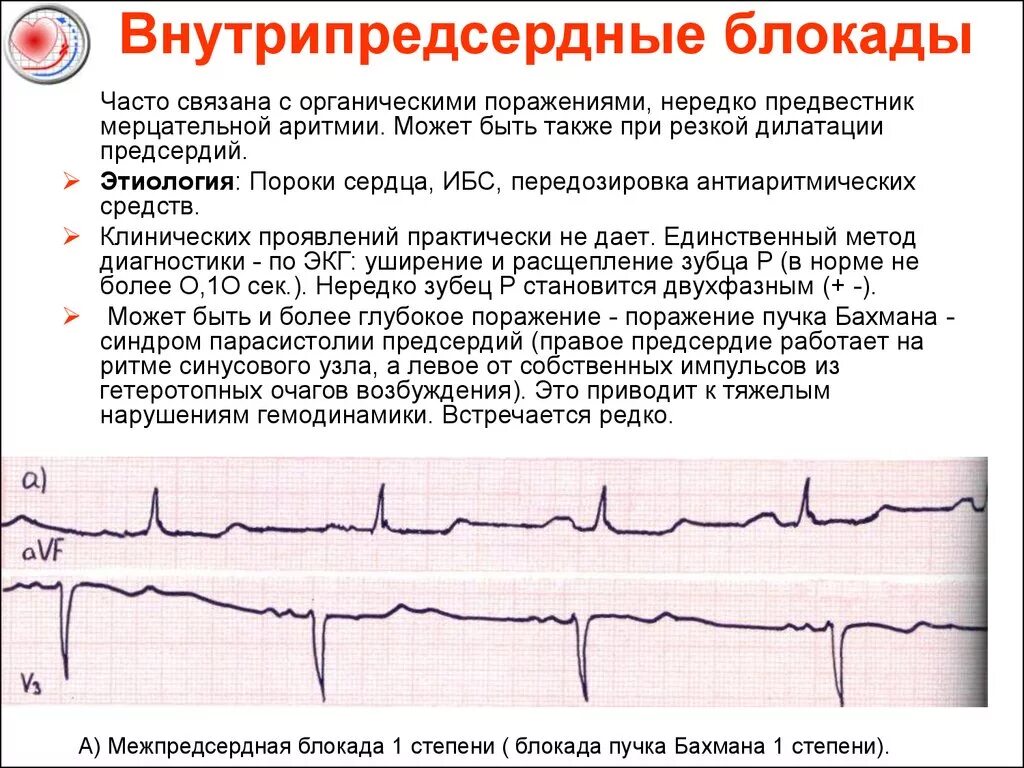 Что значит внутрипредсердная внутрипредсердная блокада