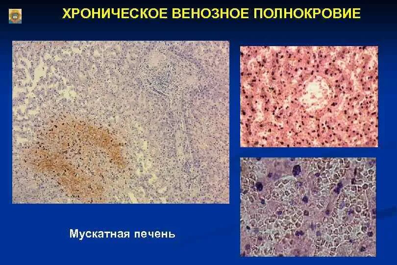 Венозное полнокровие легких бурая индурация. Хроническая венозная гиперемия. Хроническая венозная гиперемия. Венозное полнокровие в печени гистология. Мускатная печень гематоксилин эозин.
