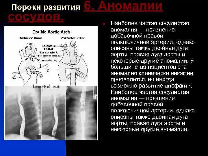 Аберрантная правая подключичная артерия. Аберрантная правая подключичная артерия артерия люзория. Правая подключичная артерия плода. Правая подключичная артерия плода. Правая подключичная от дуги аорты.