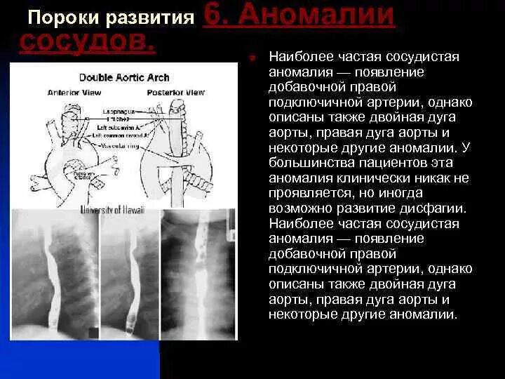 Аномалии развития аорты. Аберрантная правая подключичная артерия. Аберрантная подключичная артерия кт.