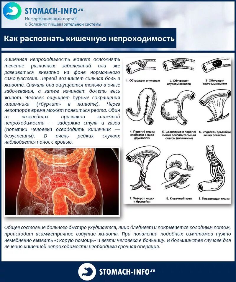 Вздутия спазмы кишечника. Спастическое сокращение кишечника. Заболевания вызывающие кишечную непроходимость. Кишечная непроходимость симптомы и синдромы. ГАЗЫ при кишечной непроходимости.