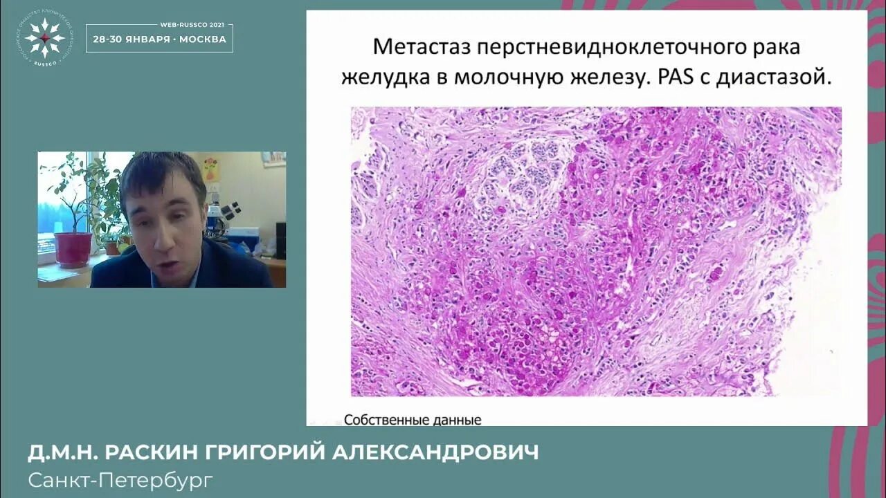 Метастазы молочной железы симптомы. Метапластическая карцинома молочной железы. раскин григорий александрович онколог. метастаз медсестры джозеф.