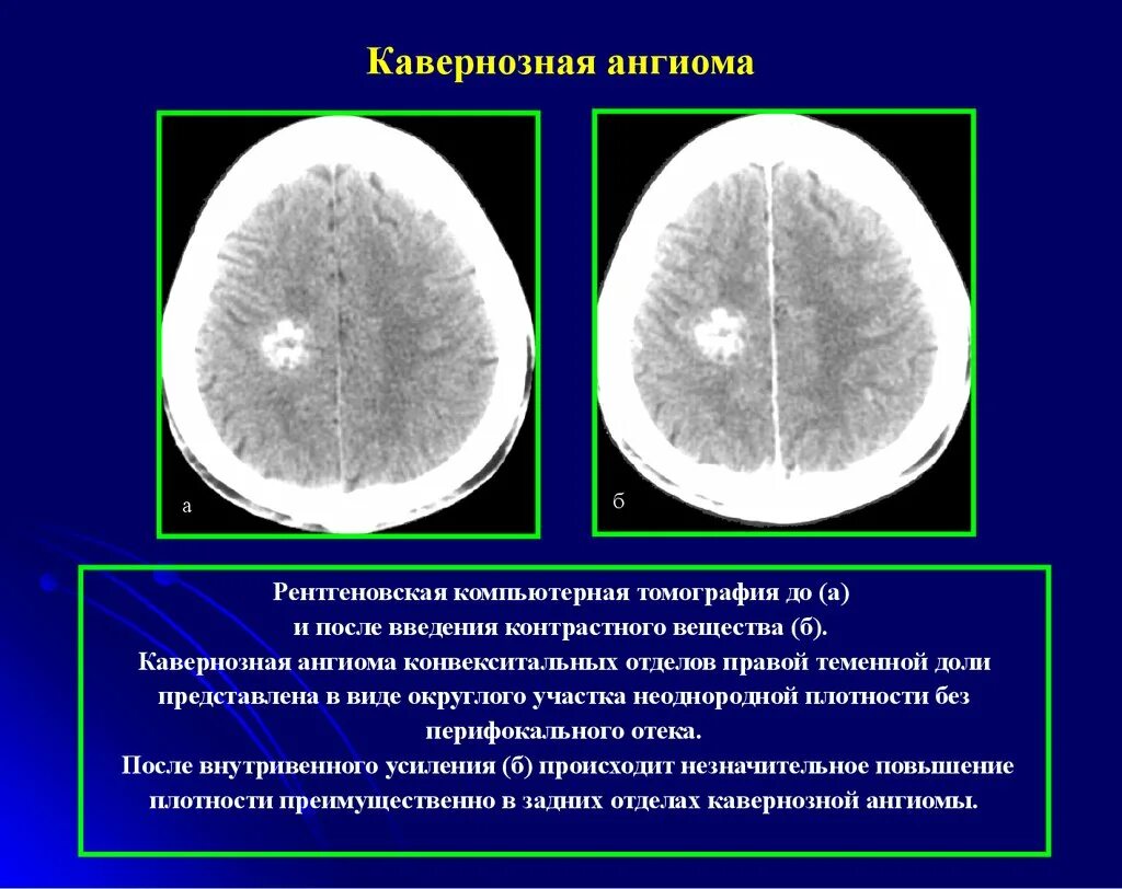 Ангиома головного мозга кт. Кавернозная ангиома головного мозга кт. Кавернозная ангиома мрт. Ангиома правой лобной