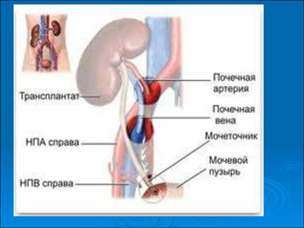 Трансплантология почки. Почечный трансплантат. Трансплантация почки схема. Пересадка почки в россии