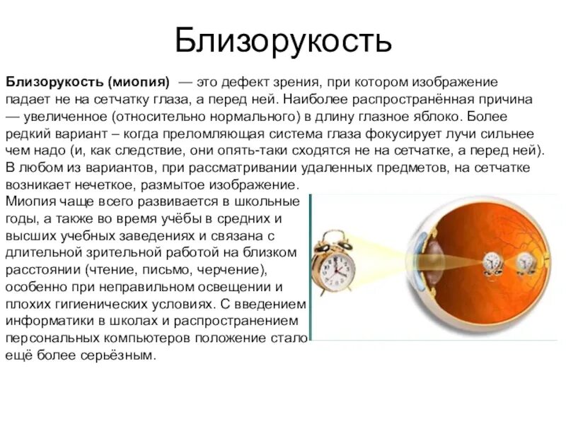 Близорукость. Зрение близорукость. Близорукость миопия. Заболевания глаз близорукость.