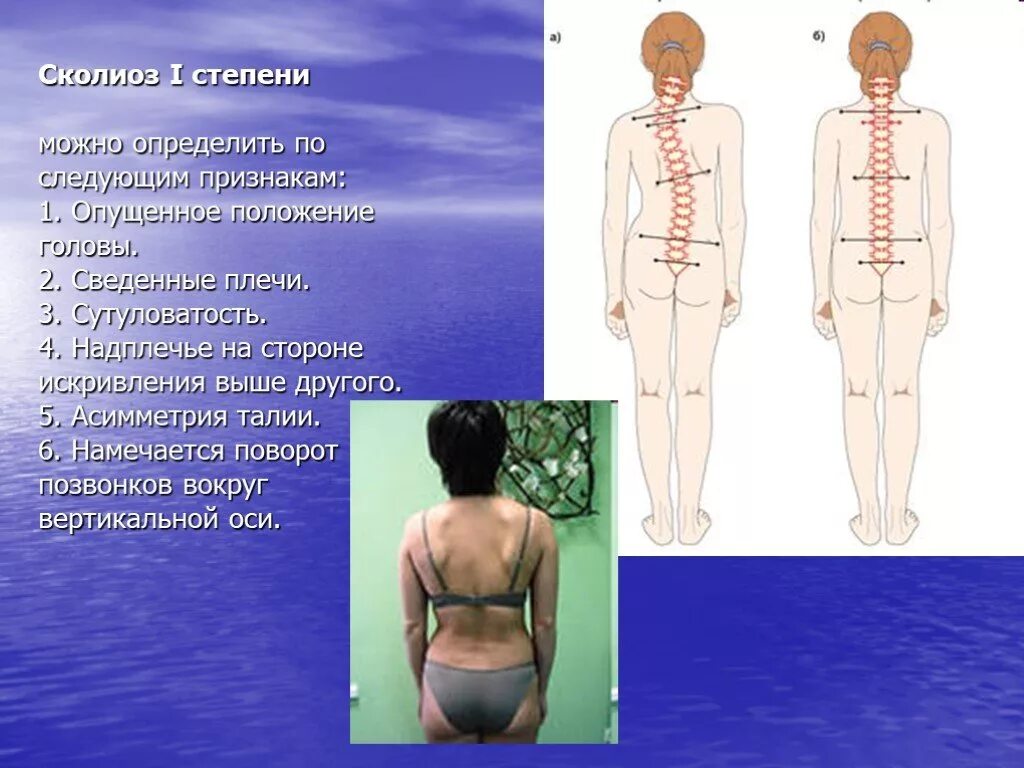 Искривление позвоночника сколиоз 1 стадия. Искривление позвоночника 2 степени. Сколиоз 2 плечи. Искривление позвоночника 4 степени.
