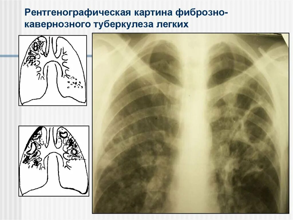 Фиброзно-кавернозный туберкулез рентген. Фиброзно-кавернозный туберкулез каверны. Фиброзно-кавернозный туберкулез легких рентген. Рентген фибринохно кавернохного туберкулеза\.