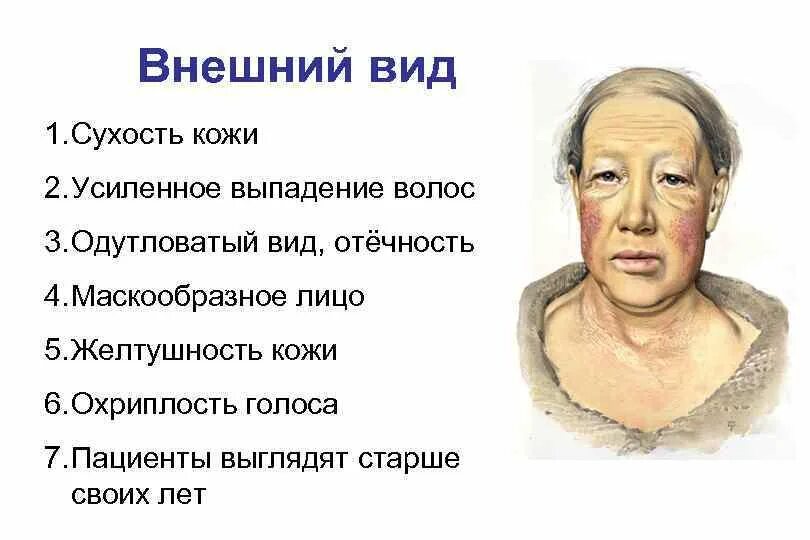 Одутловатая женщина