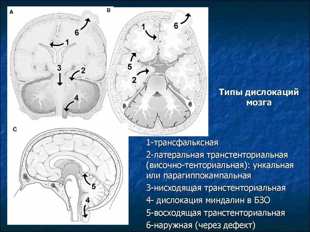 Резидуальные очаговые изменения. Смещение срединных структур головного мозга мрт. Вклинение ствола головного мозга кт. Смещение срединных структур головного мозга на кт. Латеральная дислокация срединных структур головного мозга кт.