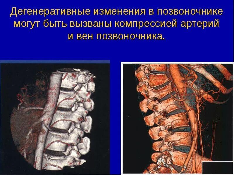 Дегенеративные дистрофические дистрофические изменения. Дегенеративно-дистрофические изменения l2 l3. Дистрофия поясничного отдела позвоночника. Дегенеративно-дистрофические изменения отдела позвоночника.