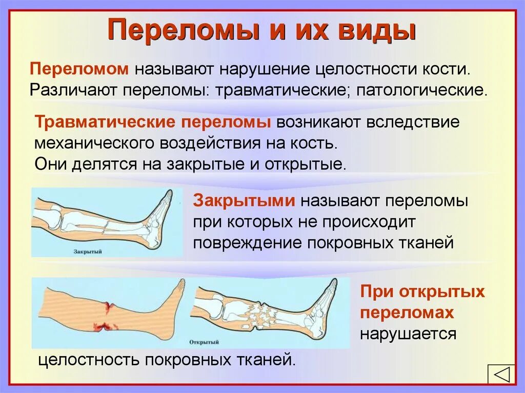 Виды переломов и первая помощь при них. Переломы костей виды признаки первая помощь. Классификация переломов костей конечностей. Перелом характеристика и первая помощь. Классификация переломов по характеру повреждения кости.