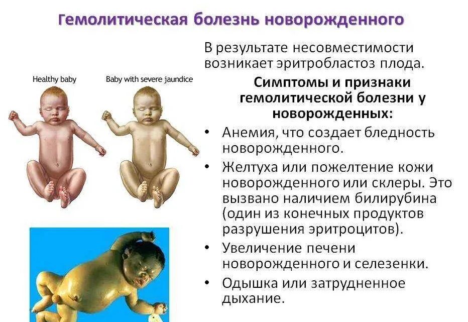 Гемолетическая болезнь новорождённого. Клинические проявления гемолитической болезни новорожденного. Гемолитическая болезнь плода. Основной метод лечения при гемолитической болезни новорожденных. Уход при гемолитической болезни.