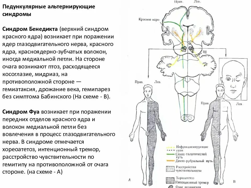 Альтернирующие синдромы схемы. Альтернирующие синдромы таблица. Альтернирующие синдромы пирамидного пути. Альтернирующие синдромы глазодвигательного нерва. Гемипарез симптомы