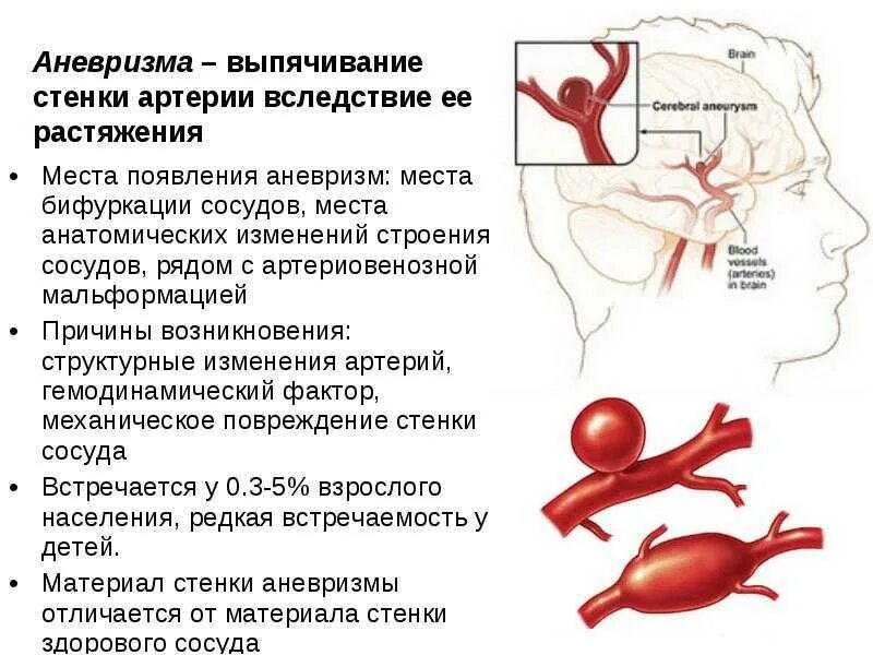 Аневризма сосудов головного мозга. Аневризма артерий симптоматика. Аневризма артерии головного мозга. Микроаневризма сосудов головного мозга.
