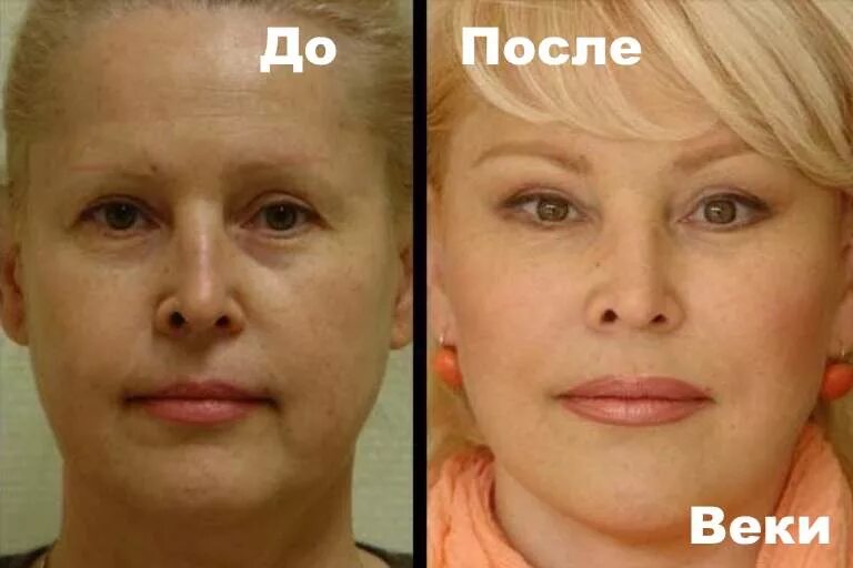 Мишки пож глазами до и после. Липолитик в лицо до и после. Липолитики под глаза. Лазерная блефаропластика век. Лазерная блефаропластика грыжи нижних век.
