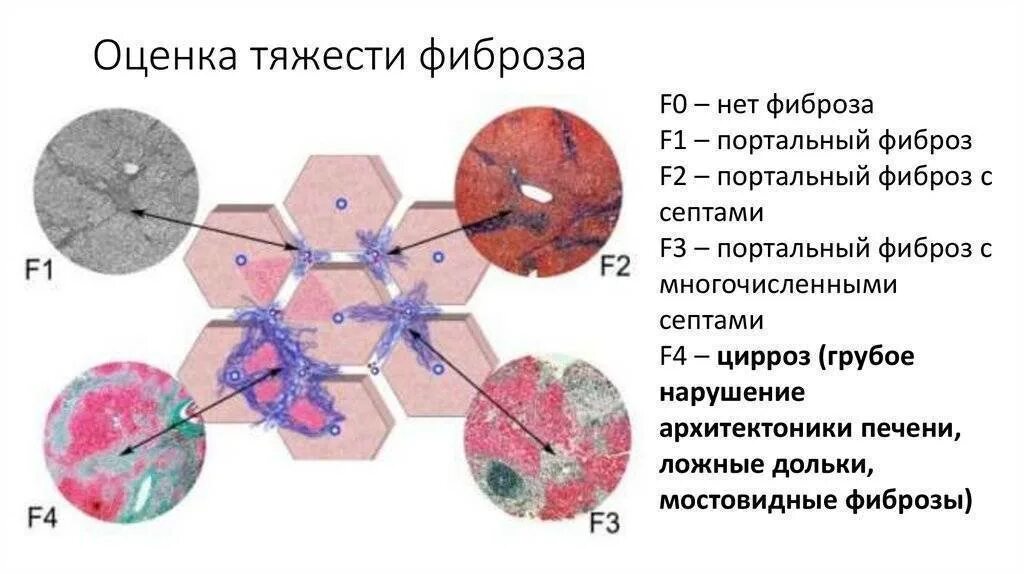 Как лечить фиброз 3. Гистологические стадии фиброза печени. фиброз печени шкала метавир фиброза печени. сердечный фиброз печени исход. фиброз и цирроз печени гистология.