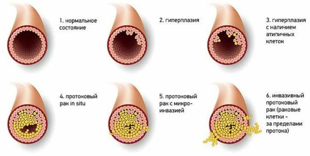 Папилломы протоков молочных желез. Папиллома железы внутрипротоковая. Протоковая карцинома in situ молочной железы. Папилломы протоков молочной железы. Протоковая папиллома молочной железы.